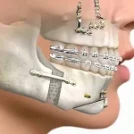 Conozca de qué se Trata la Cirugía Ortognática