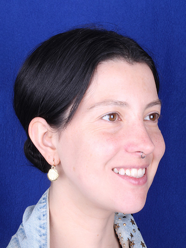 catalina-despues-lateral